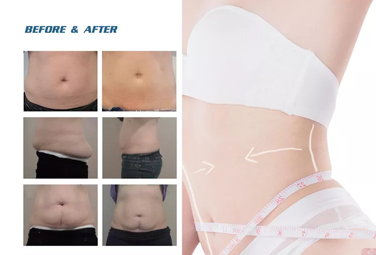 2022 Fabrikverkauf 360 Cryolipolysis Schlankheitsmaschine / Fettgefrieren Maschine Cool Tech Cellulite Reduktion