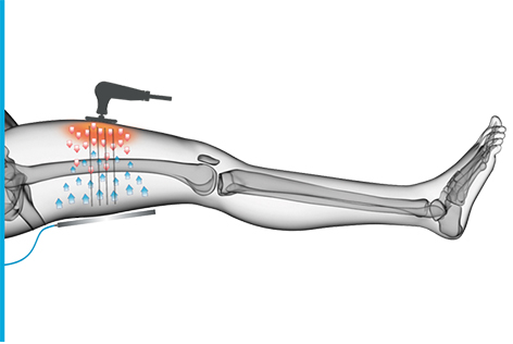 Tecar 2.1 Physiotherapie cet ret rf Therapie Schmerzlinderung physio smart 448khz tecar Maschine