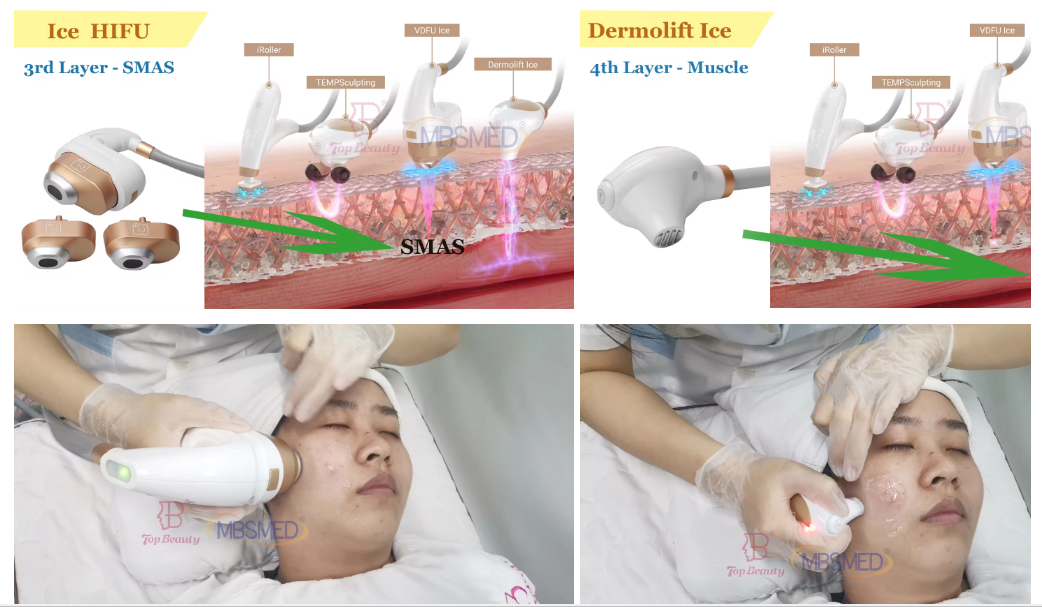 12D ICE HIFU-Gerät für Gesichtslifting, HIFU-Skin-Tightening-HIFU-Gerät