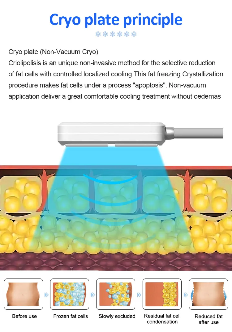 Tragbares Fettgefriergerät zur Körperformung, Entfernung von Cellulite, Kryotherapie-Gerät mit Kryoplatten und EMS