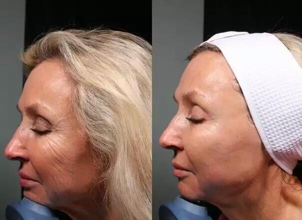 8D HIFU Vmax Hifu Gesichtslifting Schönheit Gesicht Faltenentferner Körperstraffung Hochintensives fokussiertes Ultraschall-Schönheitsgerät