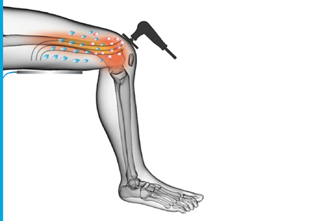 Tecar 2.1 Physiotherapie cet ret rf Therapie Schmerzlinderung physio smart 448khz tecar Maschine