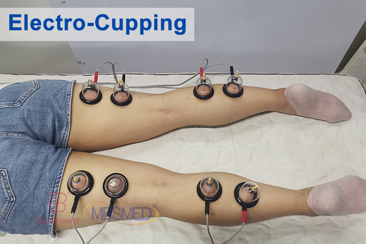 EMS-Muskelstimulator Körperstraffung Russische Welle Elektrostimulation Fair Cupping Brust Vakuum-Therapiegerät