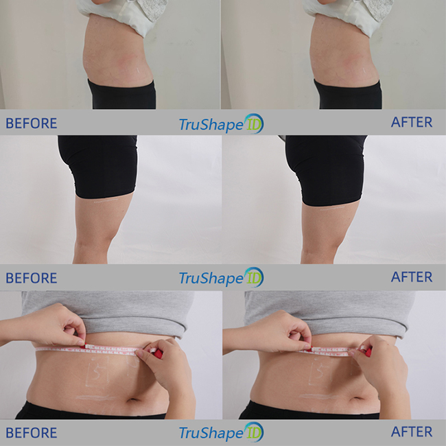 Trushape ID Behandlung Ems Elektrische Muskelstimulation Körperformung Emslim Maschine
