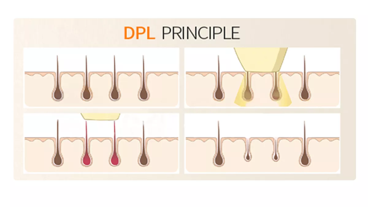 Dioden-Epilationsgerät DPL-Photonen-Hautverjüngung, -straffung und -faltenreduktion sowie Schönheitsgerät