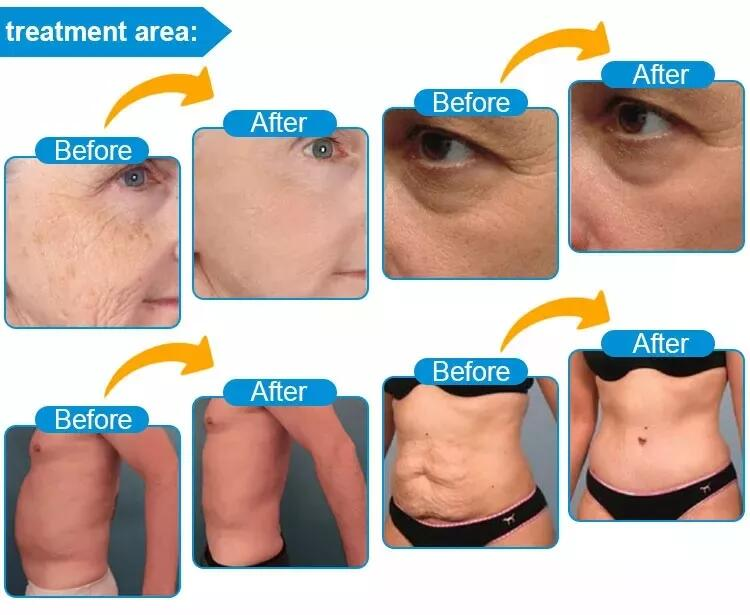 8D HIFU Vmax Hifu Gesichtslifting Schönheit Gesicht Faltenentferner Körperstraffung Hochintensives fokussiertes Ultraschall-Schönheitsgerät