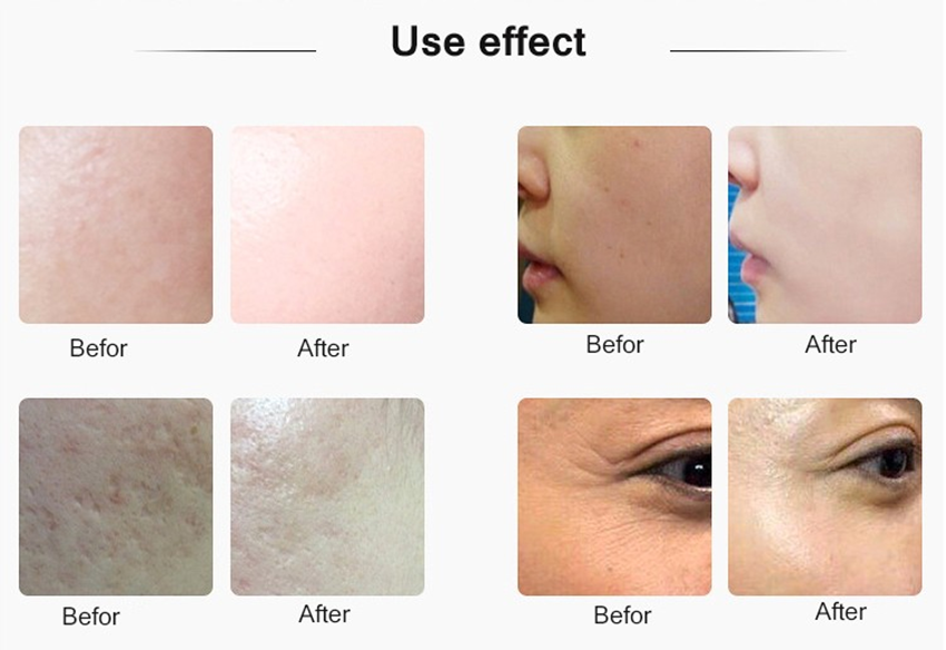 Ultraschall-Mikronadel-Rf-Mesotherapie-Injektionspistole Hautpflegegerät