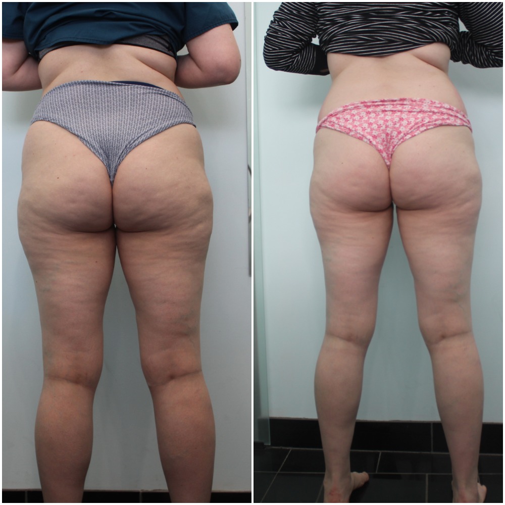Körperformende Endosphäre-Lymphdrainage-Maschine Innere Ball-Roller-Muskel-Massage-Zellulite-Reduktions-Schlankheits-Ausrüstung