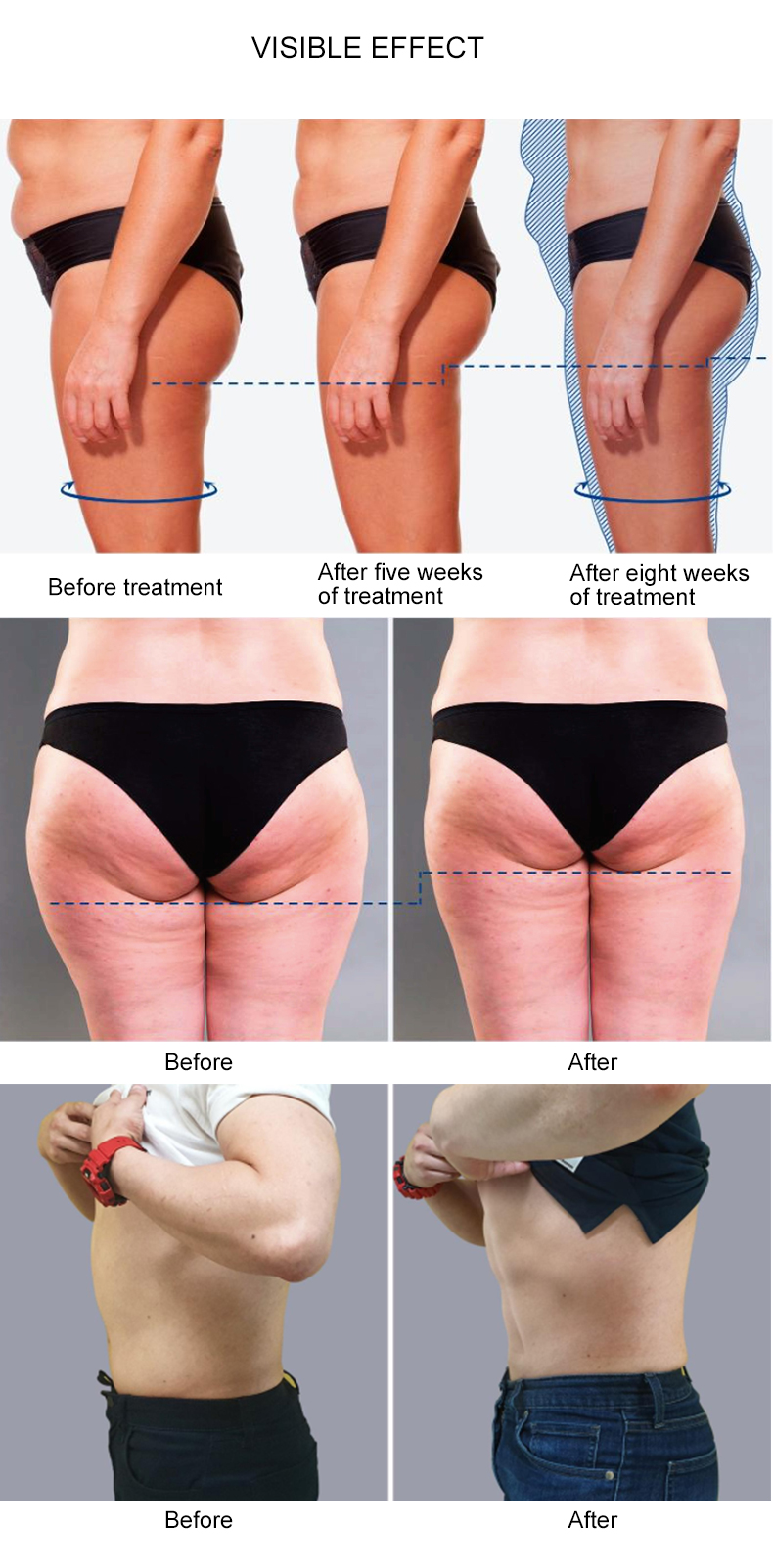 2 in 1 smas RF Schockwellentherapie-Gerät gegen Cellulite
