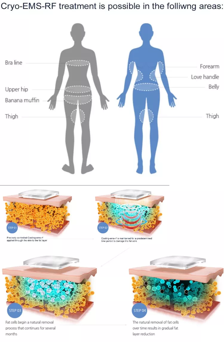 2023 Neue Fettverlust-Cryopads Schlankheitsmaschine Cryolipolyse-Maschine Coldtec Fett-Freeze Cryolipolyse-Gerät