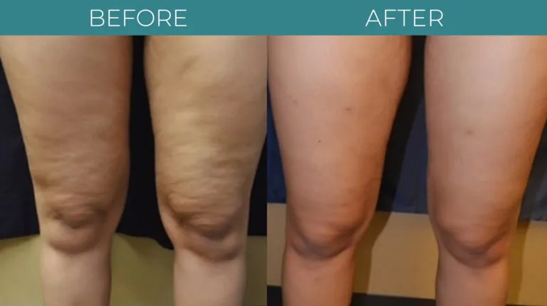 Körperformende Endosphäre-Lymphdrainage-Maschine Innere Ball-Roller-Muskel-Massage-Zellulite-Reduktions-Schlankheits-Ausrüstung