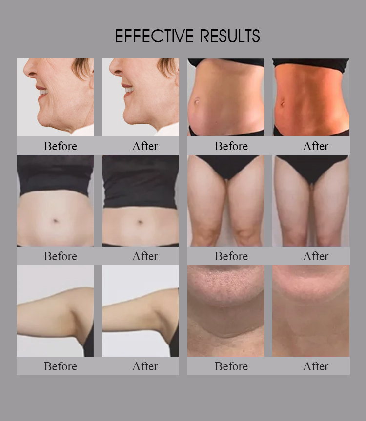 3 in 1 Salon Verwendung Trusculpt Id Flex Rf Körperkonturierung Körpermodellierung 2mhz Cellulite Behandlung Fett Reduzierung Trufat Maschine