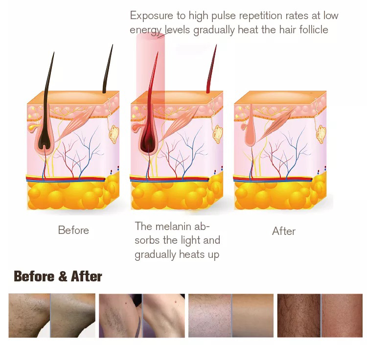 Neue Art von intensiver gepulster Lichttherapie IPL-Haarentfernungsgerät