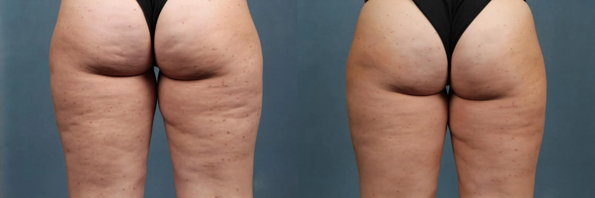 Körperformende Endosphäre-Lymphdrainage-Maschine Innere Ball-Roller-Muskel-Massage-Zellulite-Reduktions-Schlankheits-Ausrüstung
