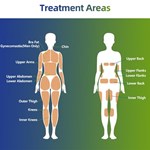 Trushape ID Behandlung Ems Elektrische Muskelstimulation Körperformung Emslim Maschine