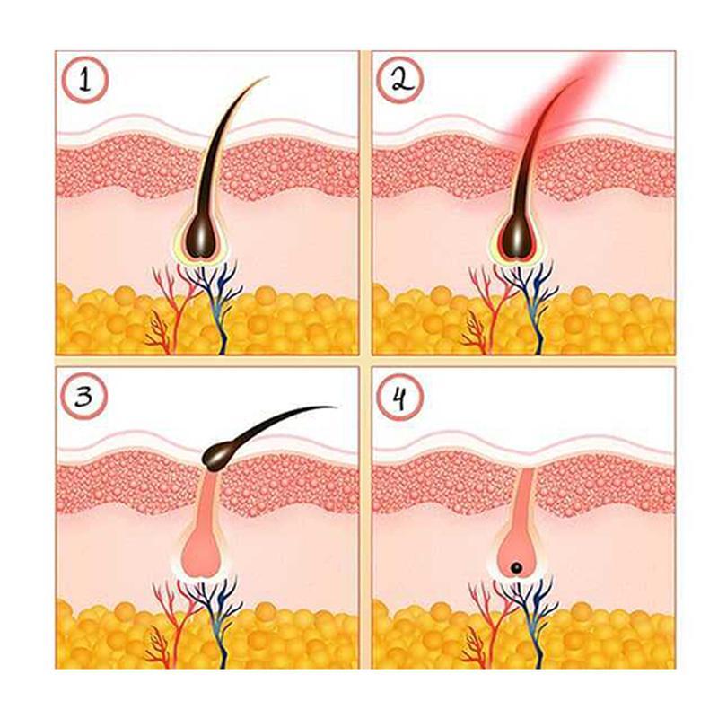 Neue Art von intensiver gepulster Lichttherapie IPL-Haarentfernungsgerät