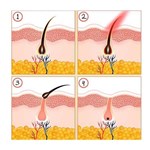 Neue Art von intensiver gepulster Lichttherapie IPL-Haarentfernungsgerät
