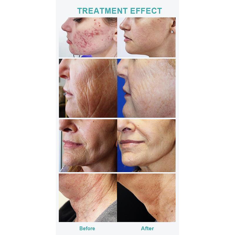 Professionelles Rf Microneedling Narbenentfernung Hautstraffung Mikro Nadling Maschine