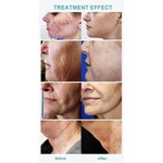 Professionelles Rf Microneedling Narbenentfernung Hautstraffung Mikro Nadling Maschine
