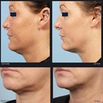 Radiofrequenz (RF) Microneedling Matrix Pros Hautfaltenentfernung