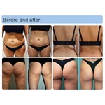 5D Vakuum-Infrarot-Roller zur Cellulite-Reduktion