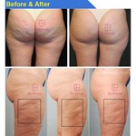 Endosphères-Roller-Massagegerät gegen Cellulite